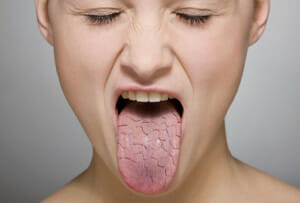 dry mouth and acupuncture