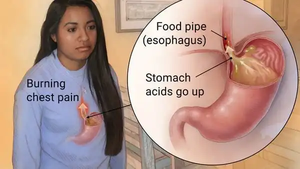 Acupuncture for Gastroesophageal reflux disease (GERD)