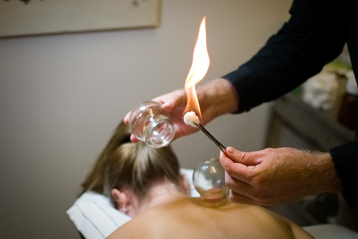 cupping therapy