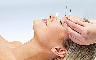 The Acupuncture Facelift Solution