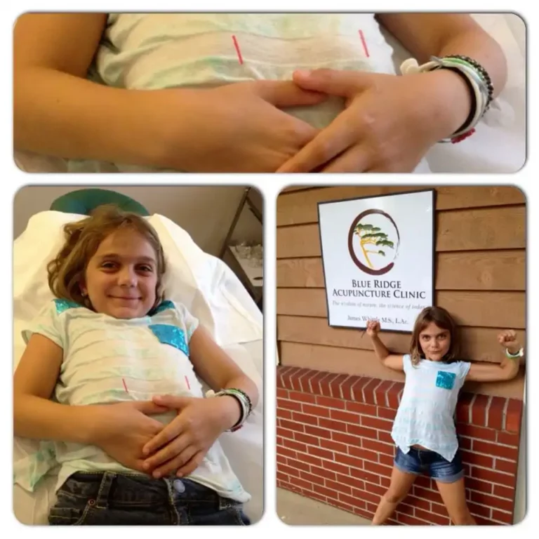 Acupuncture and Children