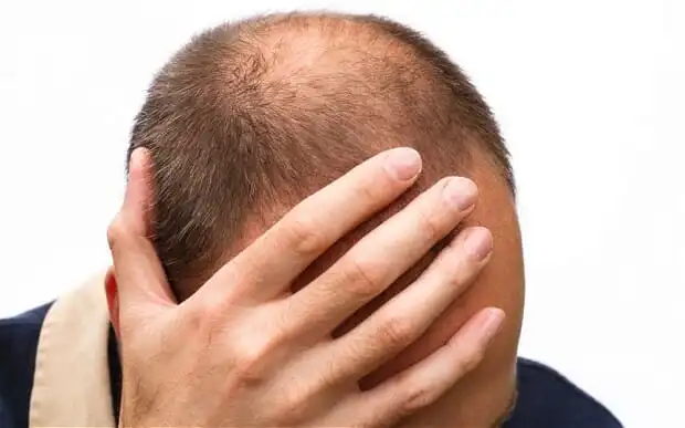 Male balding and Low T in Chinese medicine