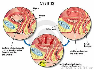 Treating Cystitis With Acupuncture and Chinese Medicine