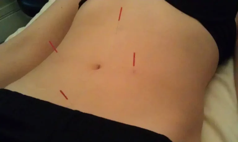 Acupuncture and Digestive Problems