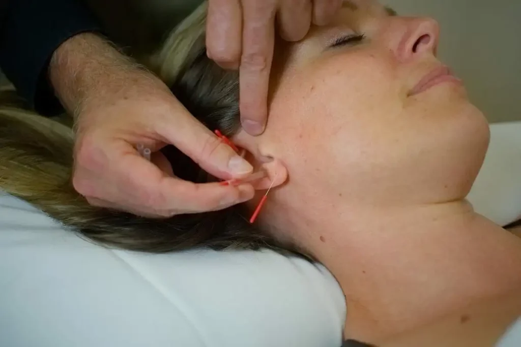 ear_acupuncture4.webp