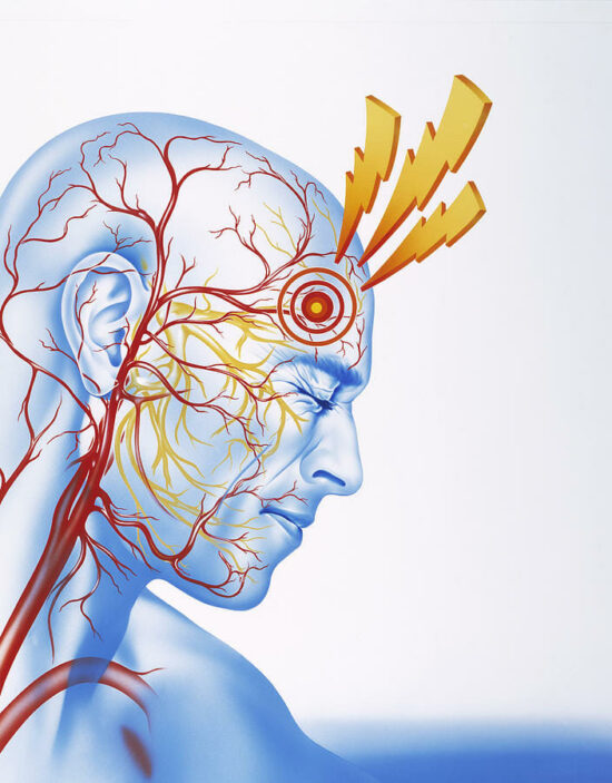 Treating Migraines With Acupuncture in Asheville
